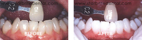 Teeth Whitening Before After Case 03