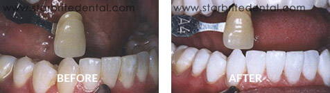 Teeth Whitening Before After Case 04