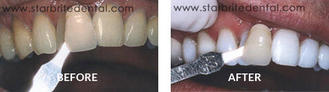 Teeth Whitening Before After Case 05
