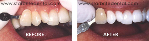 Teeth Whitening Before After Case 07