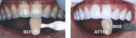 Teeth Whitening Before After Case 01
