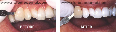 Teeth Whitening Before After Case 02