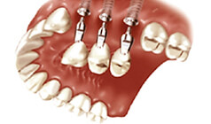  Replacement of crowns on implants 