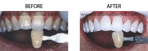 Teeth Whitening Before/After 01
