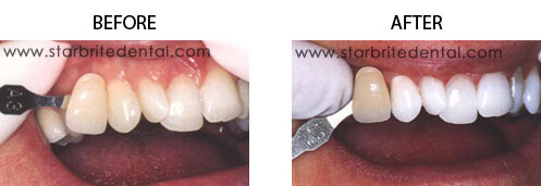 Teeth Whitening Before/After 02