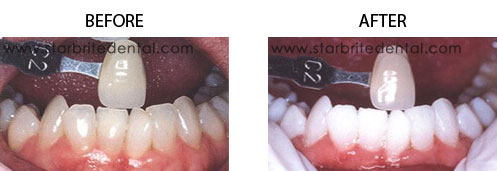 Teeth Whitening Before/After 03