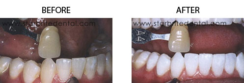 Teeth Whitening Before/After 04