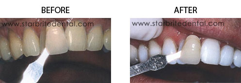 Teeth Whitening Before/After 05