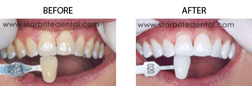 In-Office Zoom Teeth Whitening before after 01